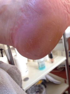 eelt verwijdert door pedicure