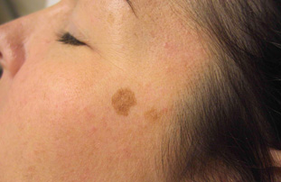 pigment in het gezicht van een vrouw